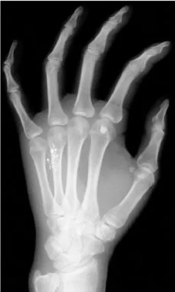 Fig. 1. Multiple sand like foreign bodies in the soft tissue around the 4th metacarpal bone.