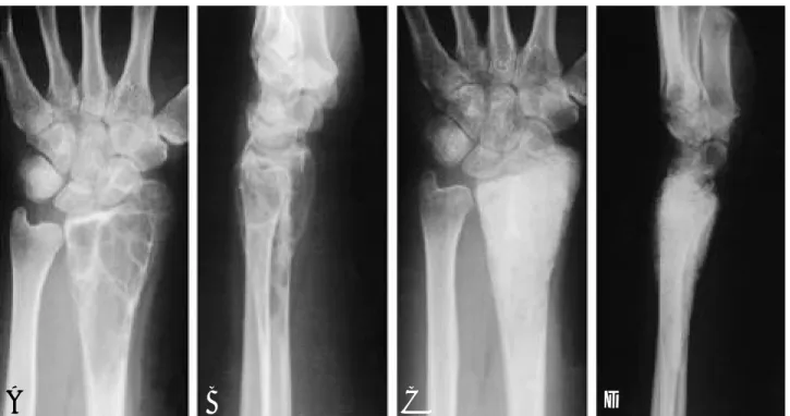 Fig. 1. A, B. AP and lateral radiographs of giant cell tumor of distal radius, revealing osteolytic cystic lesion with cortical thinning.