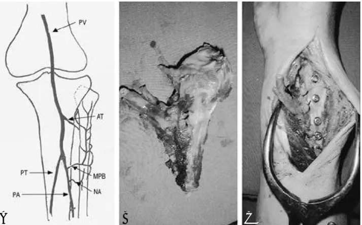 Fig. 4. Volar subluxation developed at Postoperative 19 months after vascularized fibular graft.