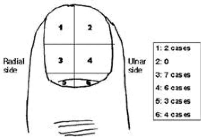 Fig. 1. The subungual glomus tumors exist in large numbers beneath proximal nail.