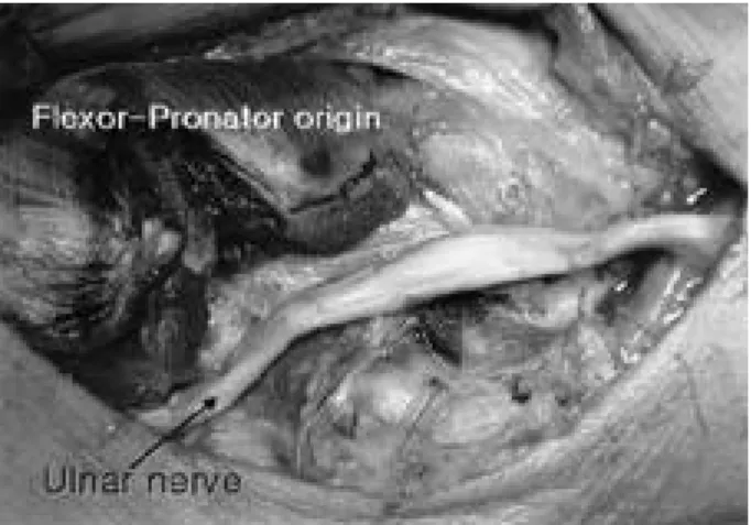 Fig. 2. The overlying structures were released, and proximal pseudoneuroma was observed around cubital tunnel.