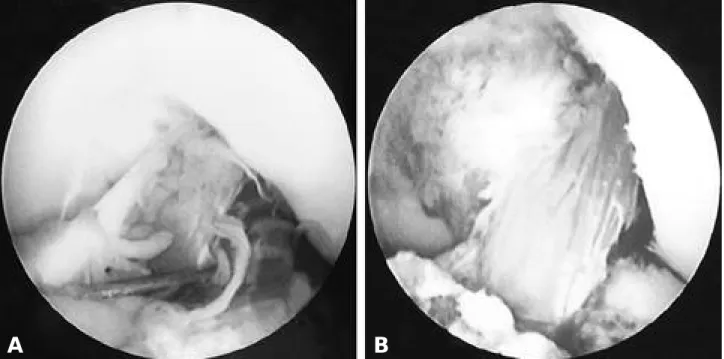 Fig. 1. The Arthroscopic view through anterolateral portal. A. Before ACL reconstruction