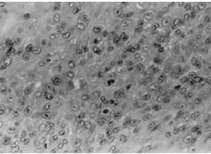 Fig. 3. Microscopic finding shows proliferating, collagen-pro- collagen-pro-ducing polyhedral cells, ferrous pigmentation, and aggregation of foamy cells (H-E stain, ×400).