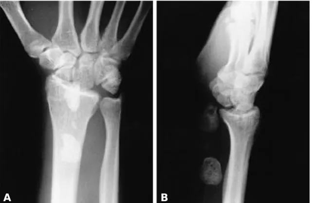 Fig. 2. Through a volar incision, the proximal scaphoid(open arrow) and lunate(white arrow) is visualized beneath the median nerve(black arrow)