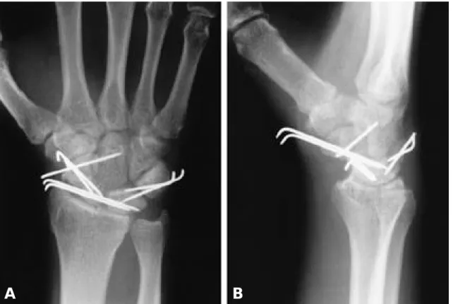 Fig. 3. Postoperative x-ray films show realignment of carpal bones fixed with multiple K-wires.