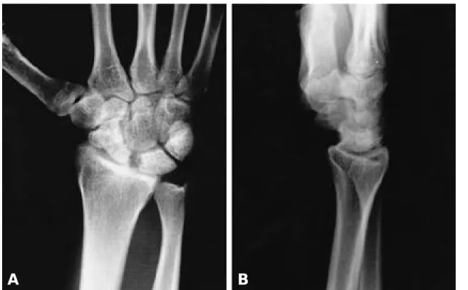 Fig. 5. X-ray films at two year after the injury show increased density of lunate and proximal scaphoid