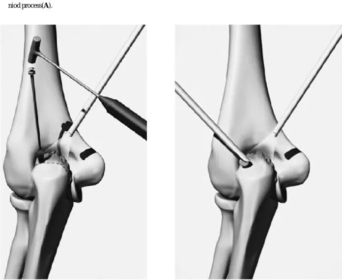 Fig. 2. Removal of the osteophyte of the olecranon with osteotome.
