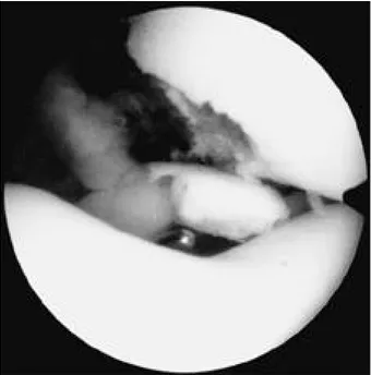 Fig. 2. This picture showed arthroscopic lateral release.