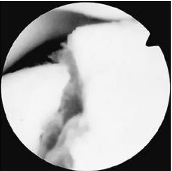 Fig. 5. Arthroscopic finding of 44 year-old female patient showed displaced osteochondral fracture fragment in lateral femoral condyle.