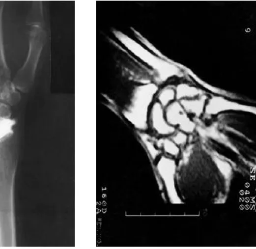 Fig. 1. The arthrographic image showing communicating defects of the triangular fibrocartilage complex between radiocarpal and distal radioulnar joint.