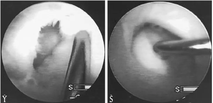 Fig. 3. Arthroscopic findings of triangular fibrocartilage complex injuries. A: Periperal type