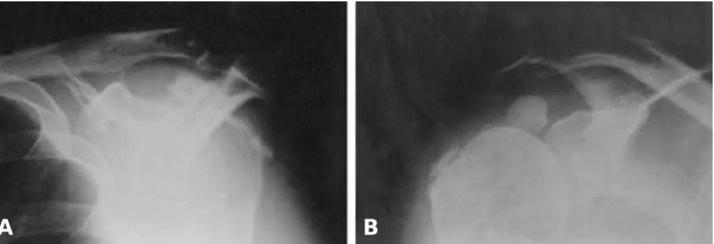 Fig. 2. Arthroscopic shaver indicated calcific deposits.