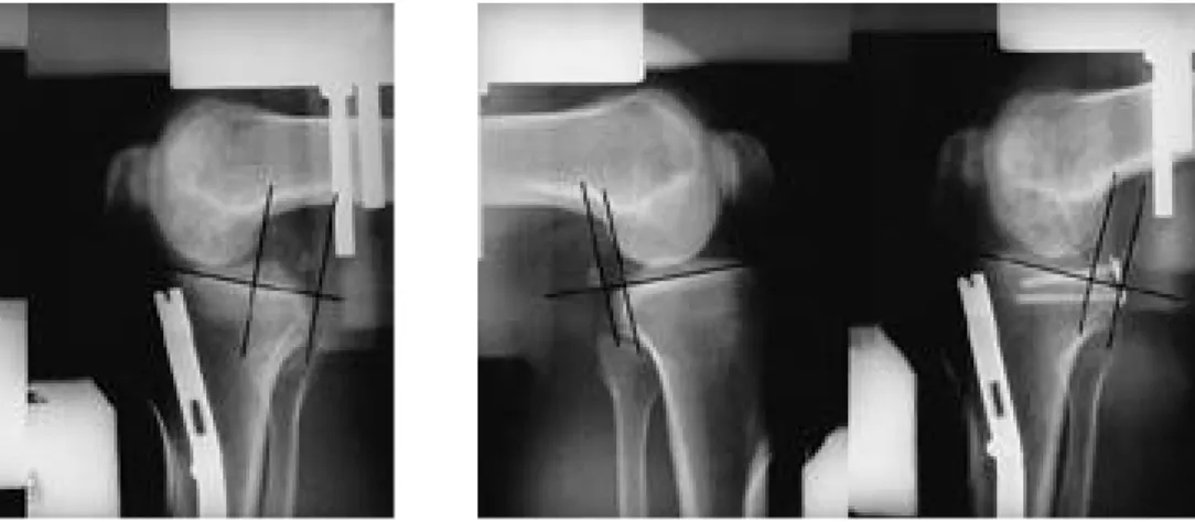 Fig. 2. Instrumented posterior laxity test with Telos ® d e v i c e showed 4mm side to side difference after PCL  recon-struction with tibial inlay technique.
