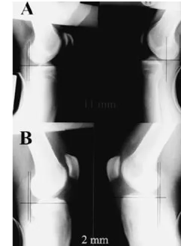 Fig. 4. Side to side difference in instrumented anterior laxity test was improved from 11mm before operation(A) to 2mm at follow up(B).