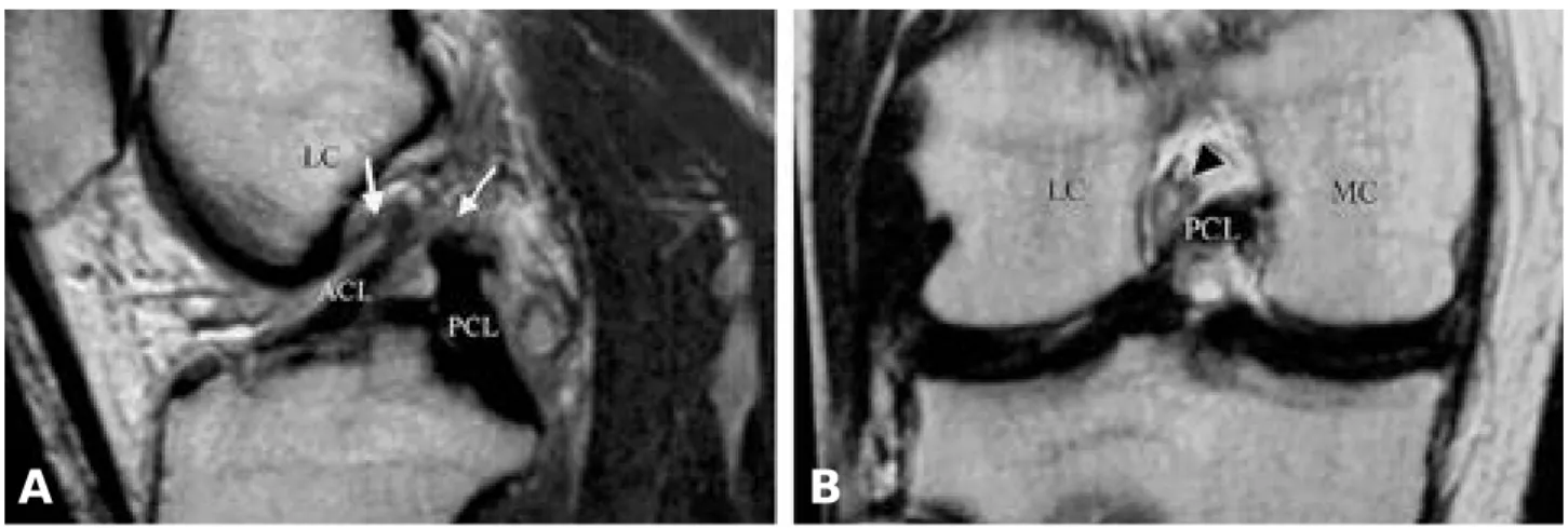 Fig. 2-A. MR sagittal image shows a single large fragment of the ACL. Note the abnormal orientation of distal fragment