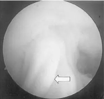 Fig. 1. Fibrous band adhered from graft to anterior capsule.