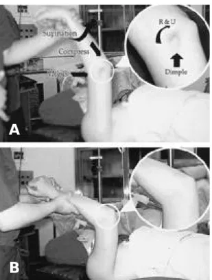 Fig. 1-A. Positive pivot shift test of the elbow(R &amp; U: