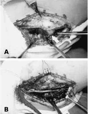Fig. 4. Lateral radiographs of elbow flexion and exten- exten-sion at 15 months after operation.