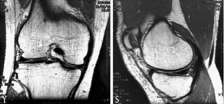 Fig. 1. MRI coronal and saggital image of right knee show normal meniscus.