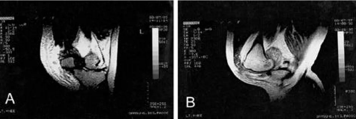 Fig. 2-B. Sagittal view of MRI. These show intermediate signal intensity noted in the intercondylar notch.