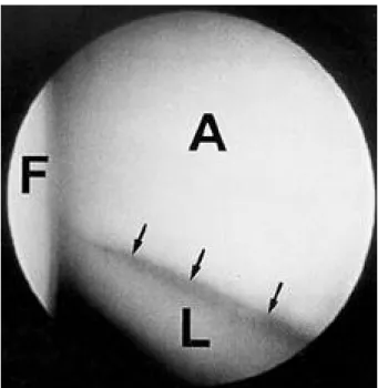 Fig. 2. Arthroscopic view shows full thickness longitudinal tear of posteroinferior labrum(arrows).