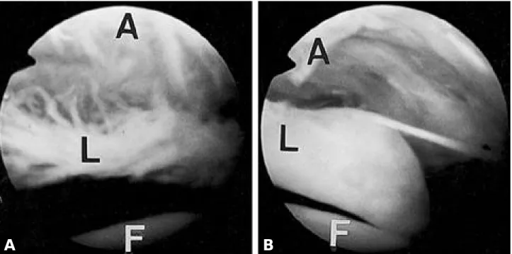 Fig. 4. Arthroscopic view shows synovial hypertrophy(arrow) (F: femoral head, C: joint capsule).