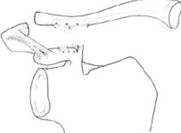 Fig. 1. Each three holes are made at the anterior portion of the clavicle and the coracoid process around the torn coracoclavicular ligaments.