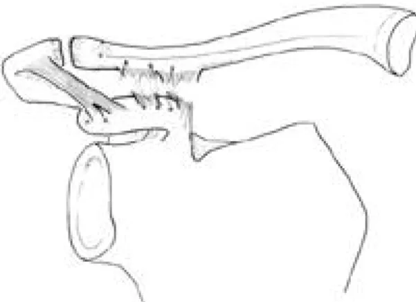 Fig. 3. After reducing the acromioclavicular joint with K-wire fixation and tying the transferred  cora-coacromial ligament, the Ethibond sutuers placed through the holes of the clavicle and the coracoid process are tied