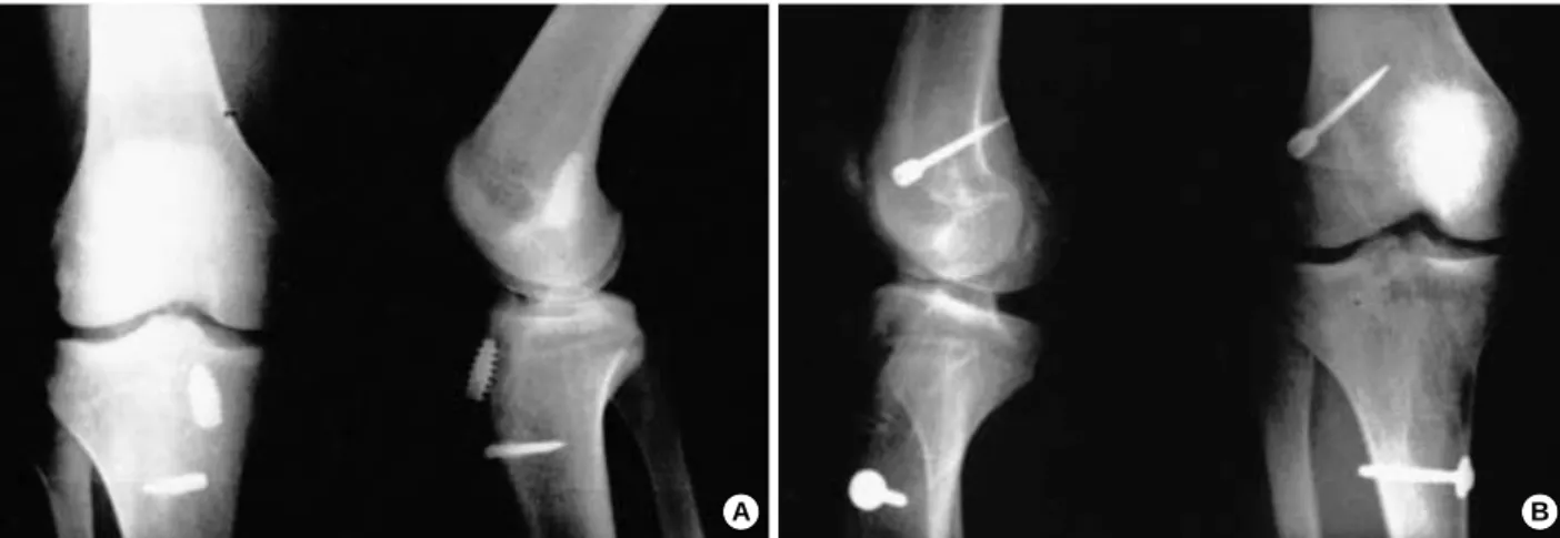Fig. 3. A: Preoperative X-ray of revisional reconstruction of ACL. B: Postoperative X-ray of revisional reconstruction of ACL.