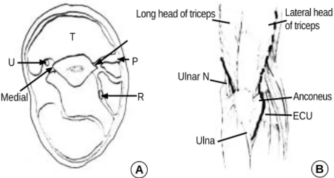Fig. 2. 40 year old woman with intraarticular fracture (AO type C3) was treated by modified lateral approach and additional medial approach without olecranon osteotomy
