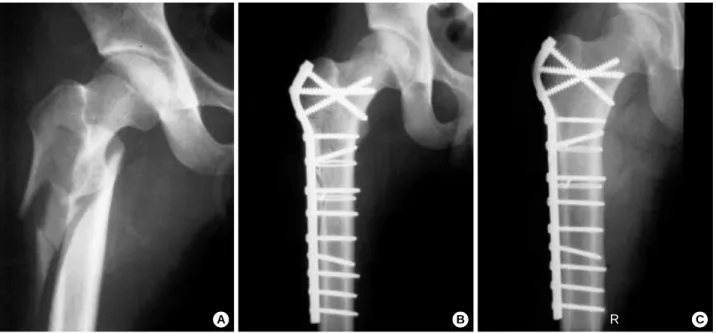Fig. 1. A: A severe comminuted subtrochanteric fracture in a 15-year man. B: A postoperative radiograph