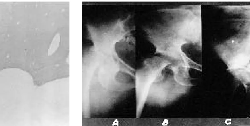 Fig. 2.  The classification according to the extent of acetabular necrosis in radiograph