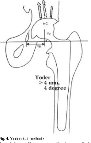 Fig. 4. Yoder et al method :