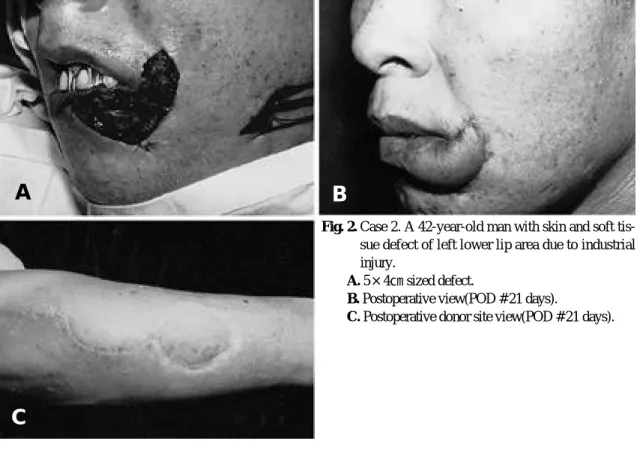 Fig. 2. Case 2. A 42-year-old man with skin and soft tis- tis-sue defect of left lower lip area due to industrial i n j u r y .