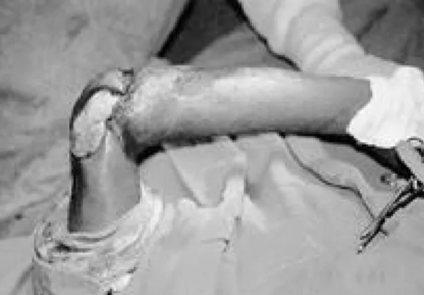 Fig. 3. Harvested toe joints with dorsal skin of the foot transplanted to the defective elbow joint in place before fixation.