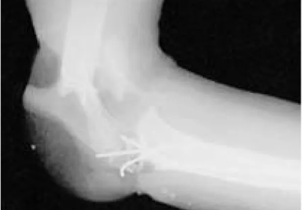 Fig. 4. Latearal radiographic finding of the trasplanted elbow joint with multiple K-wire fixation.