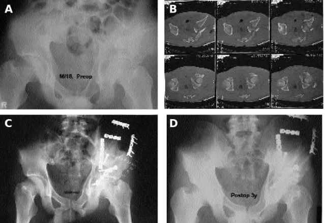 Fig. 1A-D.  Preoperative plain pelvic roentgenogram(A) and Computed tomography(B) of a 18-years-old man