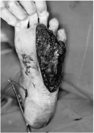 Fig. 1. An 18-year-old female patient with defect size of 13×6㎝ of the left sole is noted