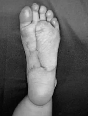 Fig. 3. A satisfactory overall contour of the left sole is noted after 7 months.