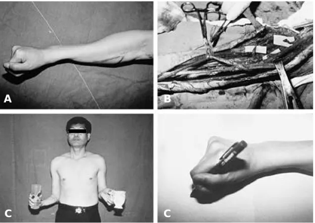 Fig. A . Preoperative photograph showing contracture of the hand. 