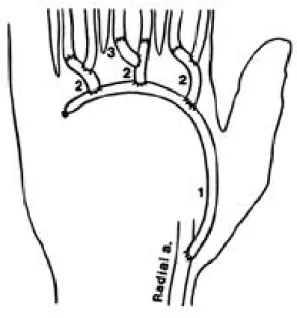 Fig. 1. Zones of amputations within the hand. Fig. 2. Schematic view of vein graft for restoration of the superficial palmar arch.