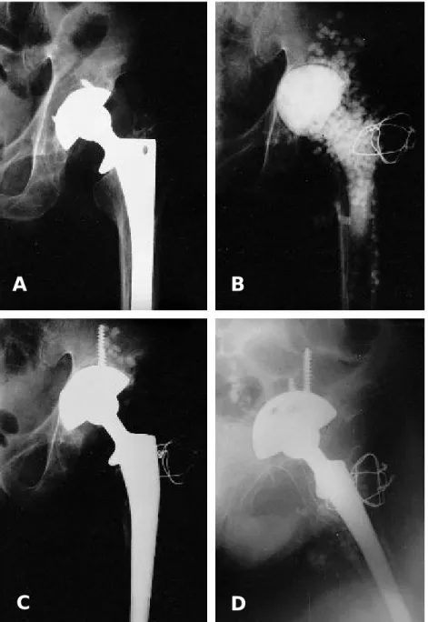 Fig. 1. A. The patient, underwent total hip arthroplasty using cementless components 6 years ago