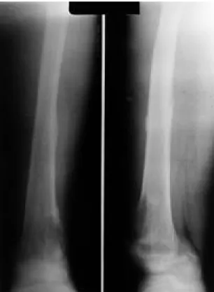 Fig. 1. Initial anteroposterior and lateral radiographs of the left distal femur of a 17-year-old male demonstrate an osteolytic lesion in the distal femur, with a pathologic fracture, poorly defined margin, amorphous densities and periosteal reaction.