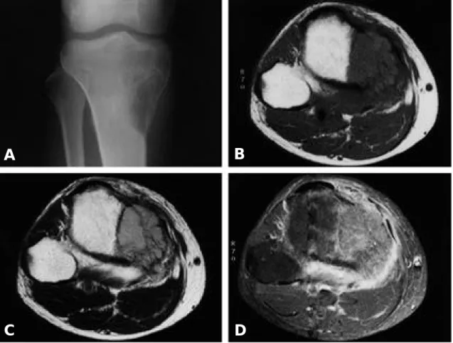 Fig. 2. A 42-years-old male with solitary plasmacytoma of left proximal tibia