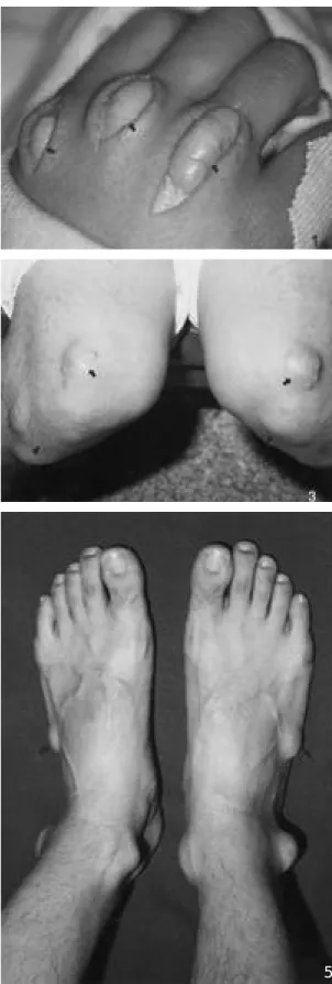 Fig. 1-5. Preoperative and intraoperative photographs showed multiple various sized palpable masses on the extensor tendon sheaths of hand (Fig
