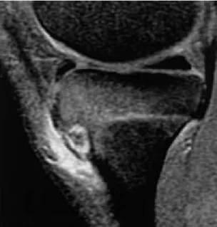 Fig. 1-B. Knee lateral : X-ray shows an osteolytic lesion with surrounding sclerotic area.