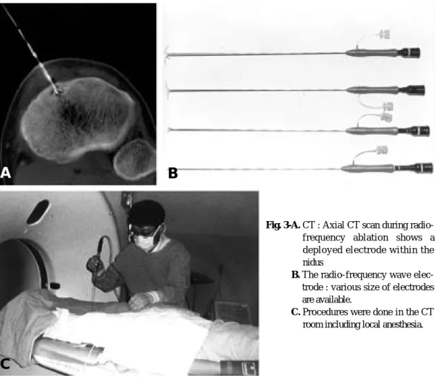 Fig. 3-A. CT : Axial CT scan during radio- radio-frequency  ablation  shows  a deployed electrode within the nidus