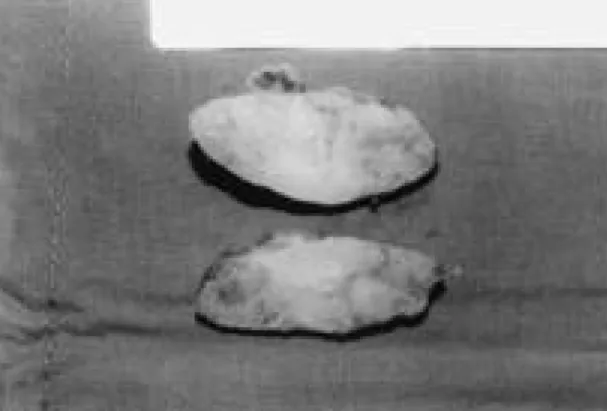 Fig. 6. Microscopically, the cells of the tumor are pre- pre-dominantly chondrocyte.