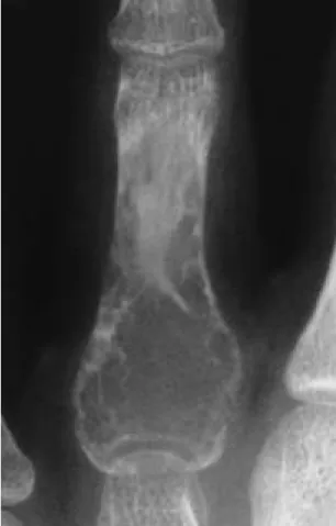 Fig. 3. Numerous giant cells are identified in a diffuse fashion with mononuclear stromal cells(H &amp; E