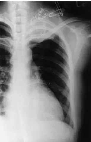 Fig. 2. MRI shows a well defined bulging mass on the left first rib. The lesion shows T1 intermediate(A)/T2 bright signal intensity(B) with cystic portions.